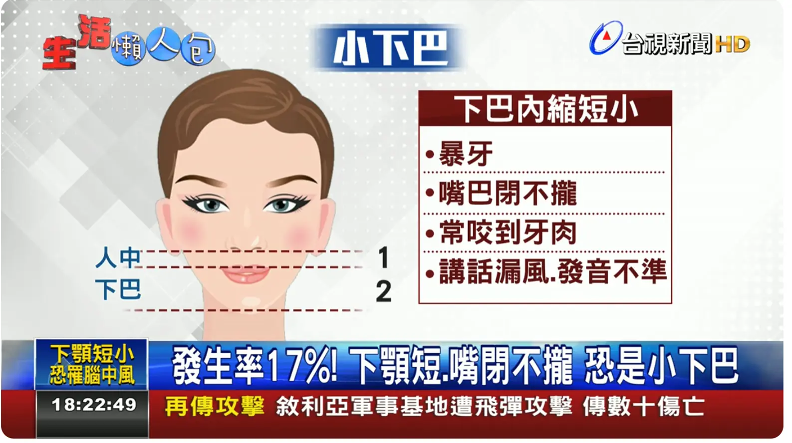 小下巴矯正 - 兒童早期生長導引 小下巴矯正 - 兒童早期生長導引