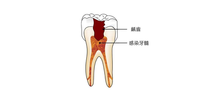 根管治療 根管治療