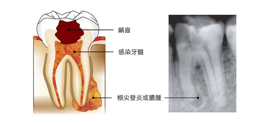 根管治療 根管治療