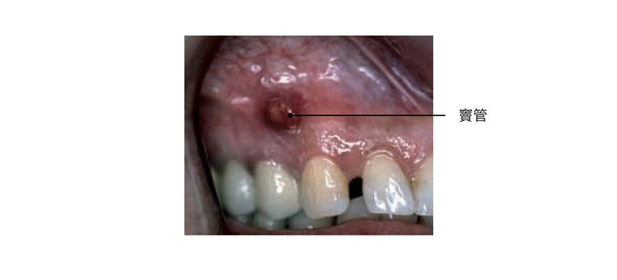 根管治療 根管治療