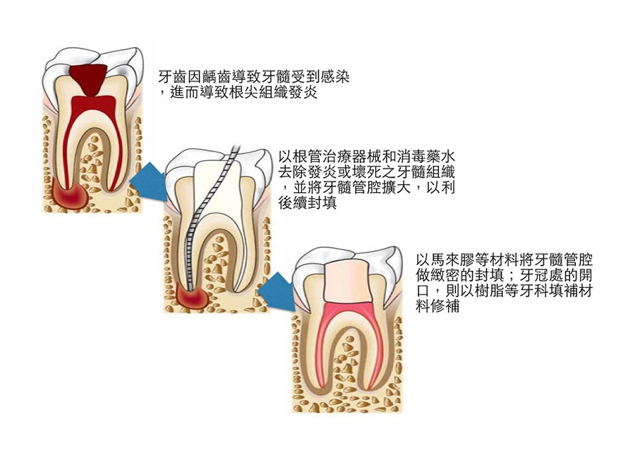 根管治療 根管治療