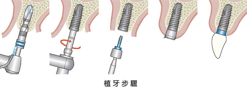 人工植牙 人工植牙