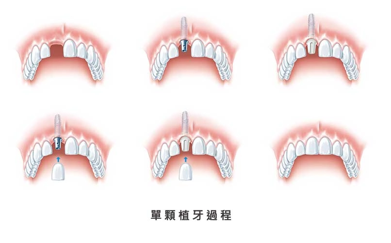 人工植牙 人工植牙