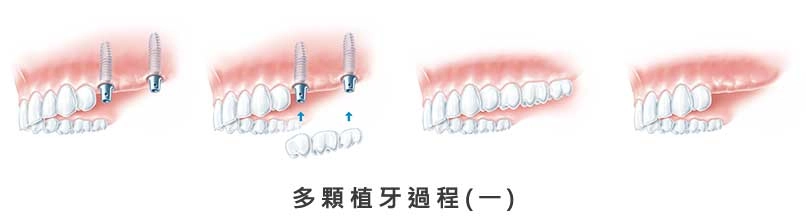 人工植牙 人工植牙