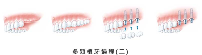人工植牙 人工植牙