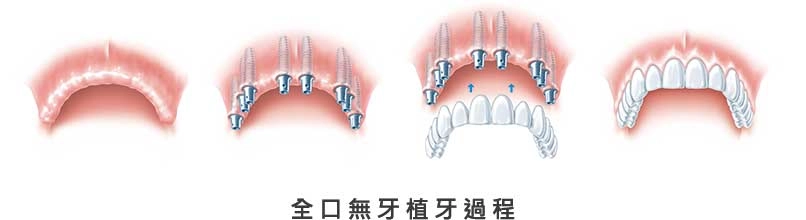 人工植牙 人工植牙
