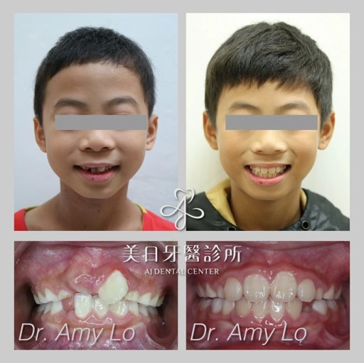 MRC肌功能矯正器 - 兒童早期生長導引 MRC肌功能矯正器 - 兒童早期生長導引