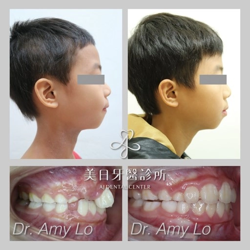MRC肌功能矯正器 - 兒童早期生長導引 MRC肌功能矯正器 - 兒童早期生長導引